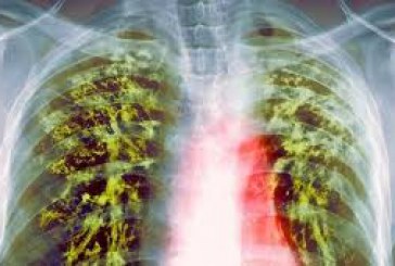Anul trecut 18 bolnavi de tuberculoză au murit în raionul Orhei