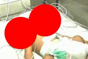 Medicii au fost ŞOCAŢI, dar au speranţe: Un BĂIAT cu DOUĂ CAPETE se luptă să supravieţuiască VIDEO