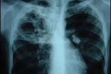 Orhei: În doar 9 luni din 2015, tuberculoza a OMORÂT  de 2 ori  mai mulţi OAMENI decât în  întregul an 2014